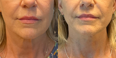 Woman treated with Neck Lift - Woman treated with Neck Lift