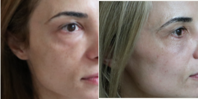 25-34 year old woman treated with Eyelid Surgery - 2 months post operative from lower eyelid blepharoplasty (for removal of puffiness and bags)