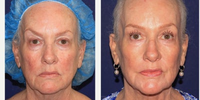Signature Take10 treatment by Dr. Groff - Signature Take10 treatment by Dr. Groff