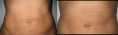 Belly Button Surgery - Female 31 years old. 
Congenital belly button abnormality with skin excess.
Photos before and 30 days after surgery.