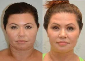 35-44 year old woman treated with FaceTite - Facetite