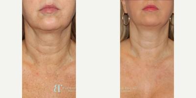 Woman treated with Profound RF - She looks ten years younger!Just look at how clear and youthful this patient's face, neck, and decollete have become after a Fotofacial with RF technology (radio frequency) treatment with Kelly! Her Skin is even more toned and brighter than before!! As a result of the RF technology, the laxity around her lower face/jawline has diminished along with fine lines and wrinkles in her neck.