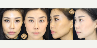 35-44 year old woman treated with Vampire Facelift - Here are Jenny's PRP before and after pictures! The before is on the left with makeup and flash. The after is on the right without makeup and no flash... and her skin still looks flawless. Note the laugh lines and the divots under the lower lips are smoothed out as well. XO