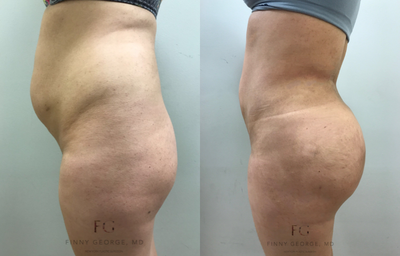 35-44 year old woman treated with Brazilian Butt Lift - This patient requested more volume and projection in her buttocks. She is shown pre-op and 3-months post-op.