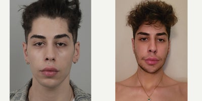 18-24 year old man treated with Cheek Implants, Facial Fat Transfer, V Line Surgery - .