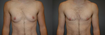 Bilateral keyhole approach with periarolar mastopexy, ( reduction and tightening of nipple/areola with incision around areola).  - 	Bilateral keyhole approach with periarolar mastopexy, ( reduction and tightening of nipple/areola with incision around areola). 6 month photo.