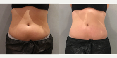 18-24 year old woman treated with UltraShape - Patient underwent 3 sessions of UltraShape Power on her abdomen at It's A Secret