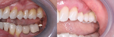 Treated with Pinhole Gum Surgery - Treated with Pinhole Gum Surgery