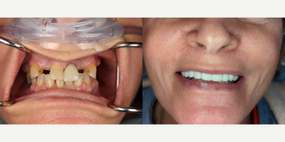 45-54 year old woman treated with All-on-4 Dental Implants - Same day custom 3d printed temporaries delivered within a few hours