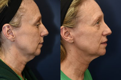 55-year old woman treated with Ultherapy - This patient was a facelift candidate but did not feel comfortable having surgery at this time. She had one Ultherapy session, two months ago. The skin will continue to tighten over the next four months.