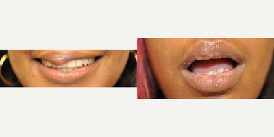 25-34 year old woman treated with Lip Reduction - 28 year old female treated with Upper Lip Reduction