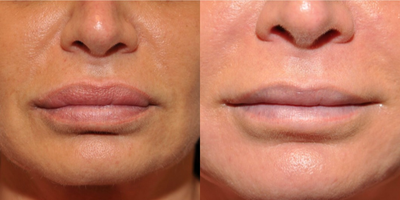 Lip Reduction - Lip Reduction