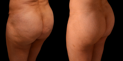 25-34 year old woman treated with Cellfina - cellulite improvement with subcision and fat transfer.