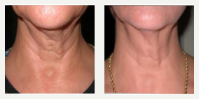 55-64 year old woman treated with Skintyte - Skintyte