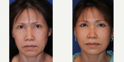 55-64 year old woman treated with Facelift - 58 year old femaleUpper Face Lift