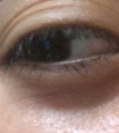 I'm 17 and have bad wrinkles. What should I do about them ...