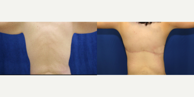 25-34 year old woman treated with Back Lift - This patient was unhappy with the excess skin and fat on her back. She underwent an upper body lift (also known as a horizontal torsoplasty). She is very happy with her results.
