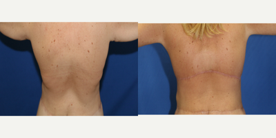 25-34 year old woman treated with Back Lift - This patient was unhappy with the excess skin and fat on her back. She desired a flat back. Dr. Katzen was able to remove excess skin and fat off her back by performing an upper body lift (also known as a horizontal torsoplasty). She loves her results.