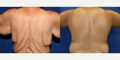 45-54 year old woman treated with Back Lift - This patient went through a large amount of weight loss. She was not happy with the rolls on her back. She underwent a torsoplasty or upper body lift with Dr. J. Timothy Katzen. She is very happy with the outcome of her surgery.