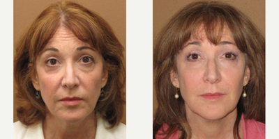 Woman treated with Sculptra Aesthetic - Woman treated with Sculptra Aesthetic