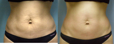 TriPollar - 
	Tummy skin tightening after 1 treatments. Photos supplied by manufacturer, Pollogen Ltd, All Rights Reserved.
