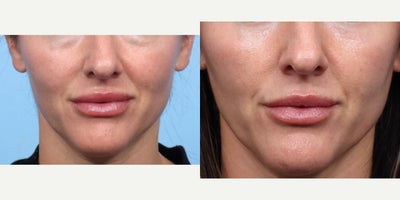 35-44 year old woman treated with Eyelid Surgery, CO2 Laser - To remove this patient's under eye bags and tighten the surrounding skin, Dr. Wise performed a lower transconjunctival blepharoplasty along with CO2 laser.