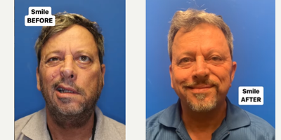 Man treated with Brow Lift, Eyelid Surgery, Neck Lift - This patient suffered traumatic facial nerve injury 6 months before the first photo. I took him to the OR for a brow lift, eyelid weight, lower eyelid tightening, left sided nerve to massester transfer and left side face and neck lift. He was able to achieve this smile just 4 months after our operation.