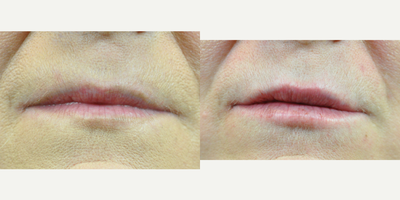 55-64 year old woman treated with Volbella - Volbella