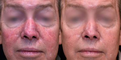 65-74 year old man treated with Vbeam - Multiple vascular laser sessions spaced 2-6 weeks apart.