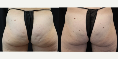 45-54 year old woman treated with Qwo - Patient underwent 3 sessions of QWO, spaced 3 weeks apart each in order to significantly reduce cellulite dimpling on the buttocks.