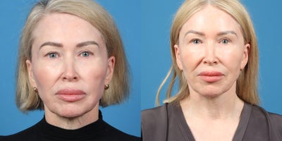 55-64 year old woman treated with Facelift, Neck Lift - MINI FACELIFT. NECKLIFT.SCAR REVISION