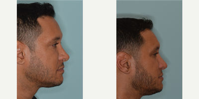 25-34 year old man treated with Revision Rhinoplasty - Male revision rhinoplasty patient who desired correction to his nose after two previous rhinoplasties.  He was bothered by the pinched and asymmetric appearance to the tip of his nose and the upturned appearance to the nose on the profile.  Revision rhinoplasty techniques included rib cartilage harvest for correction of the pinched tip and the counterrotation of the nose from the profile to provide for a straighter appearance to the nose.