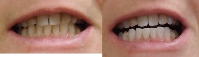 Teeth Whitening Procedure for a Female - 
	Patient wanted pearl white teeth. She wanted the stains on her teeth to disappear. After a single ZOOM teeth whitening session, the desired results were achieved.
