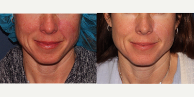 35-44 year old woman treated with Photodynamic Therapy - Before and after of patient treated with PDT for redness on the cheeks, nose, and chin.
