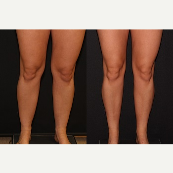 Liposuction of the Knees, Calves, and Ankles - Liposuction of the Knees, Calves, and Ankles