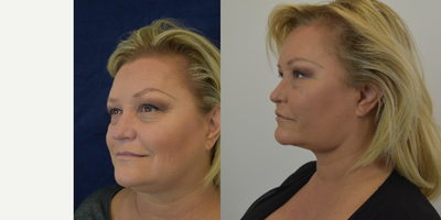 25-34 year old woman treated with Chin Liposuction - We used a combination of chin liposuction, buccal fat removal and skin resurfacing to sharpen this womans neck and jawline.
