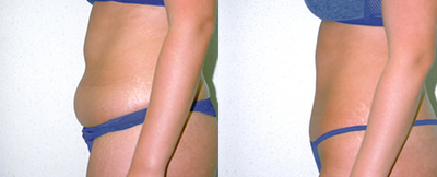 Woman treated with Liposuction - Woman treated with Liposuction