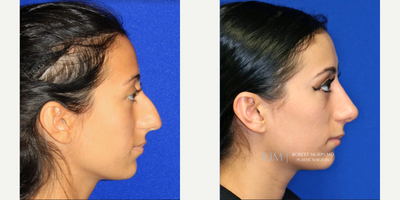 Woman treated with Rhinoplasty - Woman treated with Rhinoplasty