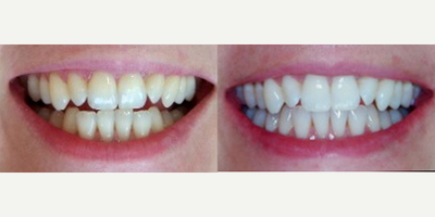Zoom Whitening - 29 year old female wanting to put pizzaz back into her smile. This is the result after a 1 hour whitening treatment in our office using the Zoom Whitening Advanced Power system. The patient was given a desensitizing toothpaste to use for 2 weeks after treatment.