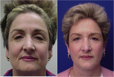 Facial Rejuvenation - Facial Rejuvenation Before & After Photos