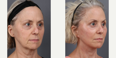 Woman treated with Deep Plane Facelift, Neck Lift, Eyelid Surgery, Facial Fat Transfer - Stunning transformations with Dr. Marotta at Marotta MDOur patient achieved remarkable results with:.- Deep Plane Face & Neck Lift.- Lower Blepharoplasty.- Fat TransferDr. Marottas personalized approach and expert guidance ensure patients feel supported and empowered from consultation to post-care, making their aesthetic dreams a reality with confidence.