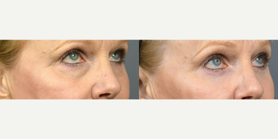 Woman treated with Eyelid Surgery, Facial Fat Transfer - Another patient who looks after her Lower Blepharoplasty and Fat Transfer with Dr. Marotta. It's a little fat transfer and lower eyelid lift.