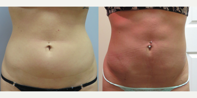 18-24 year old woman treated with Smart Lipo - Body sculpting with Tickle Lipo and smartlipo combination