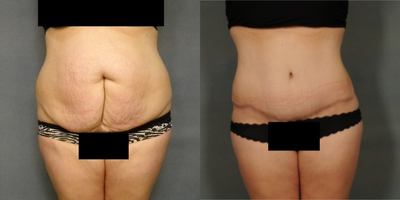 45-54 year old woman treated with Tummy Tuck - 1732 grams removed.