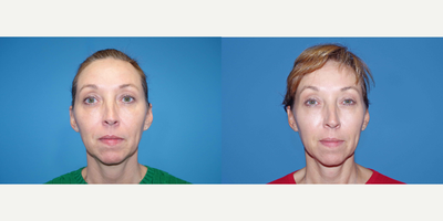 45-54 year old woman treated with ArteFill - 51 year old female received Bellafill to the nasolabial folds; photos depict the patient's results 8 months post-op.