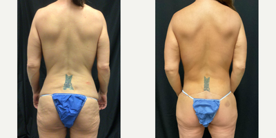 35-44 year old woman treated with Mommy Makeover, Tummy Tuck, Sientra Breast Implants, Breast Implants, Breast Augmentation - Mommy Makeover after weight loss