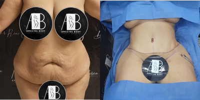 25-34 year old woman treated with Body-Jet Liposuction  - Beautiful result from tummy tuck with body tite
