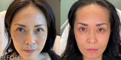 Woman treated with Moxi - Woman treated with Moxi