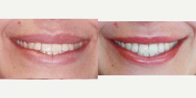 25-34 year old woman treated with Zoom Whitening - This patient desired whiter teeth. Zoom Teeth Whitening was used to achieve brighter, whiter teeth. Patient was very happy with results.