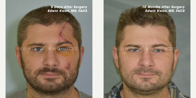 25-34 year old man treated with Facial Reconstructive Surgery, Scar Optimization Therapy - 25-34 year old man treated with scar optimization therapy.  Patient suffered a terrible car accident which left a large prominent scar on his left forehead and scalp.  He underwent meticulous laceration repair followed by scar optimization treatments afterwards.  He had multiple rounds of radiofrequency microneedling as well as intense pulsed light treatments for approximately 12 months.